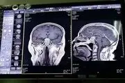 نگه‌دارنده فلپ جمجمه با ویژگی‌های خاص در ایران تولید شد