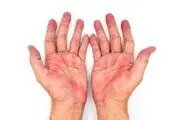 این تغییرات در کف دست‌ها نشانه بیماری کبدی است