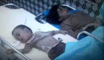 آمار یونیسف از قتل عام کودکان یمنی