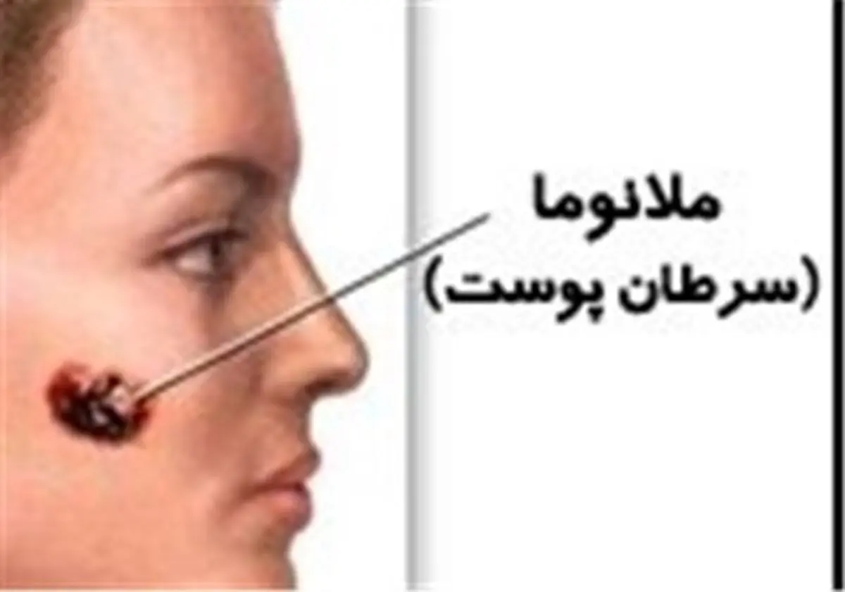 سادهترین راه جلوگیری از سرطان بدخیم پوست