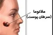ساده‌ترین راه جلوگیری از سرطان بدخیم پوست
