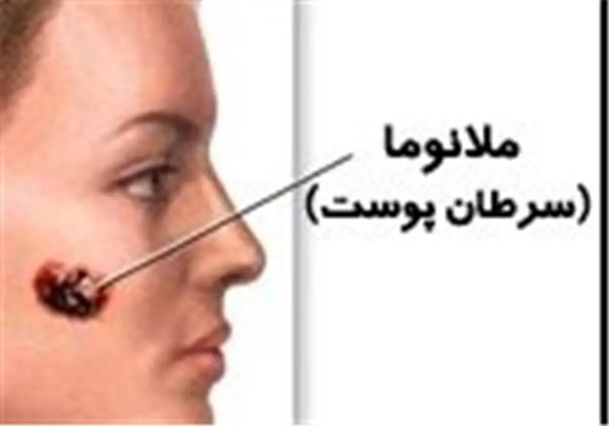 ساده‌ترین راه جلوگیری از سرطان بدخیم پوست