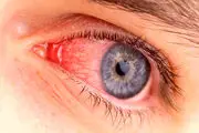 7 علامت خطرناک لکه خونی در چشم که نادیده گرفته می‌شوند