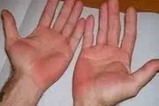 
علامت و تغییر خطرناک در دست‌ها را جدی بگیرید