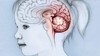 کشف راهی برای درمان احتمالی سرطان مغز در کودکان
