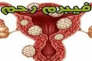 انواع درمان فیبروم بدون معطلی
