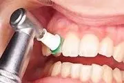 آیا جرم‌گیری به مینای دندان آسیب می‌زند؟