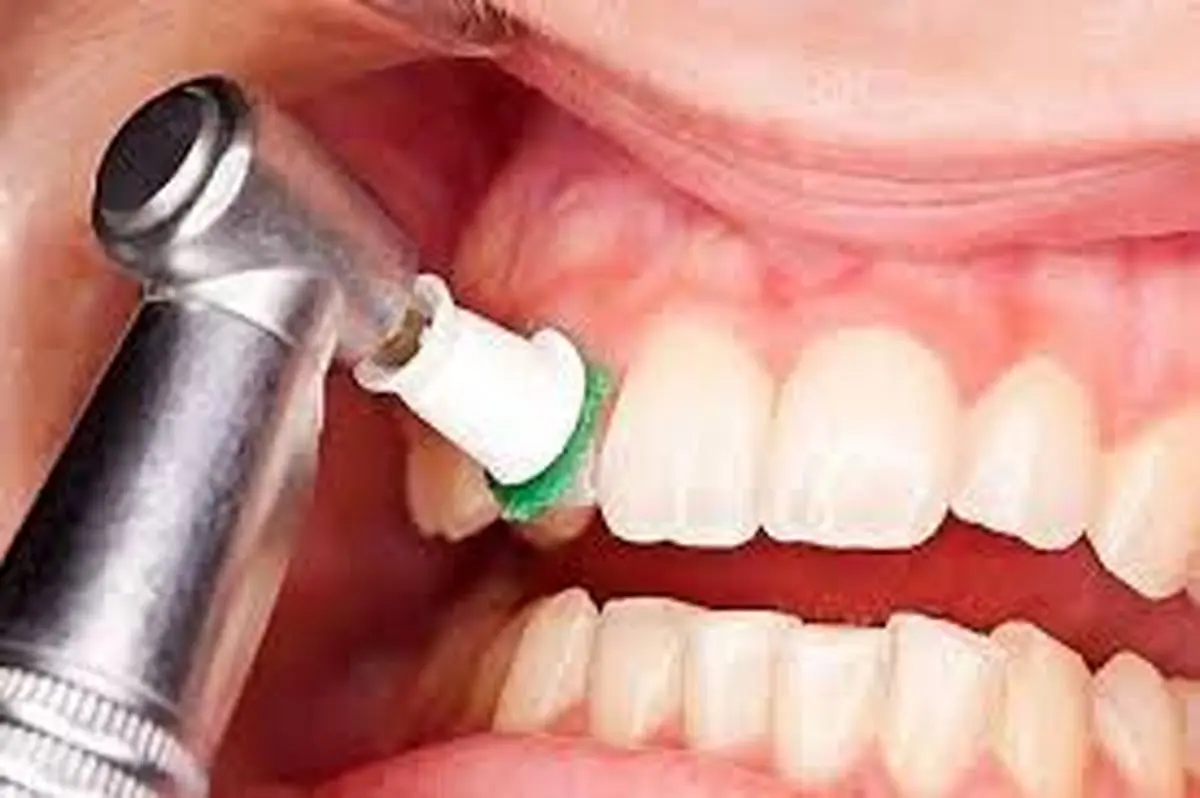 آیا جرمگیری به مینای دندان آسیب میزند؟