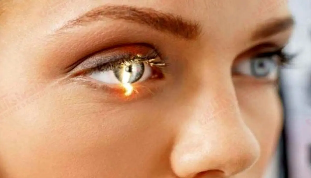 مبارزه با "گلوکوم" چشم به کمک فناوری
