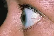 چرا چشم‌ها از حدقه بیرون می‌زند؟