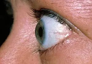 بیماری «میگرن چشمی» چیست؟