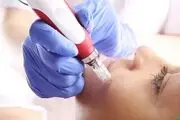 پرمویی زنان چیست؟+  راههای درمان
