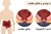 تفاوت شقاق مقعدی با بواسیر (هموروئید) چیست؟
