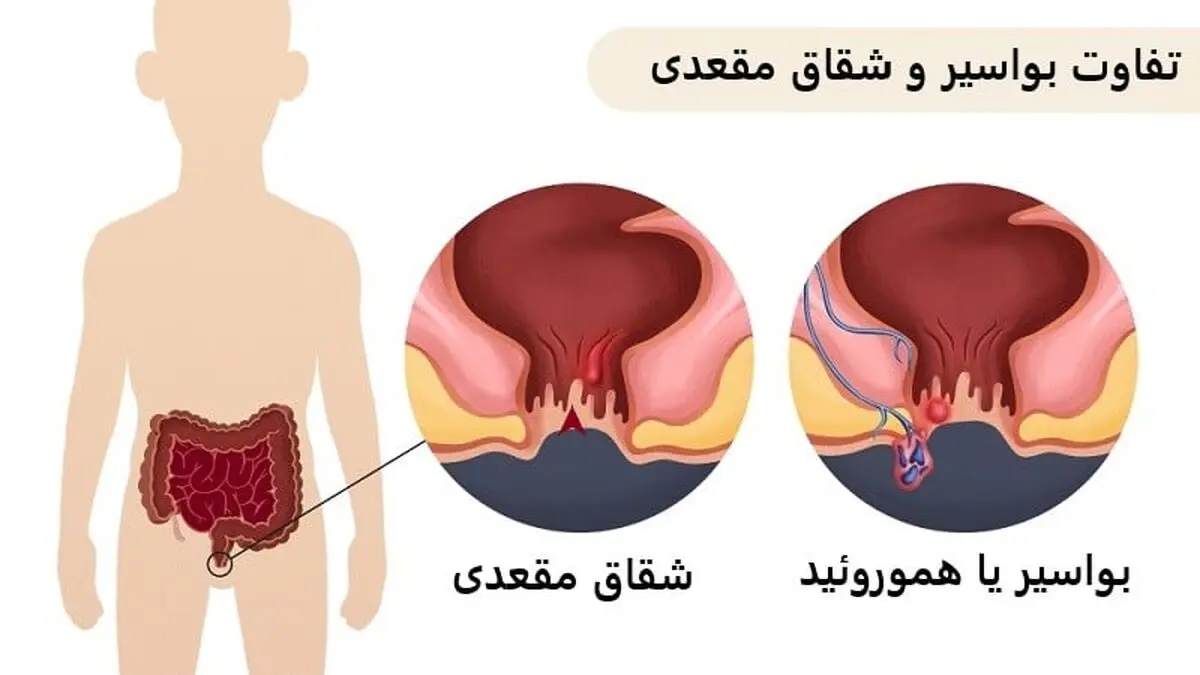 تفاوت شقاق مقعدی با بواسیر (هموروئید) چیست؟
