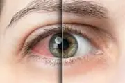 رابطه میان خشکی چشم و آسم چیست؟
