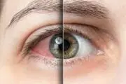 رابطه میان خشکی چشم و آسم چیست؟
