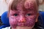 سندروم پوستی عجیب کودک 6 ساله همه را متحیر کرد+تصاویر