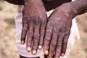 آبله میمونی خطرناک است؟
