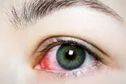 کمکهای اولیه ضربه و آسیبهای مختلف به چشم