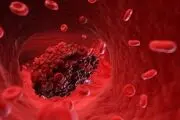 این علایم نشان وجود لخته در رگ‌هاست!