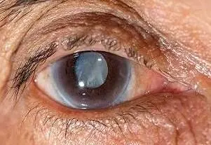 این بیماری خطرناک چشمی را بشناسید