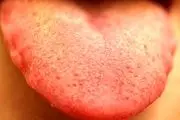«زبان» مرموزترین عامل سرطان