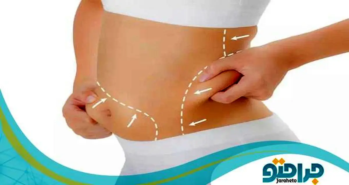 هزینه لیپوماتیک توسط بهترین پزشک در سال 1401 چقدر است ؟