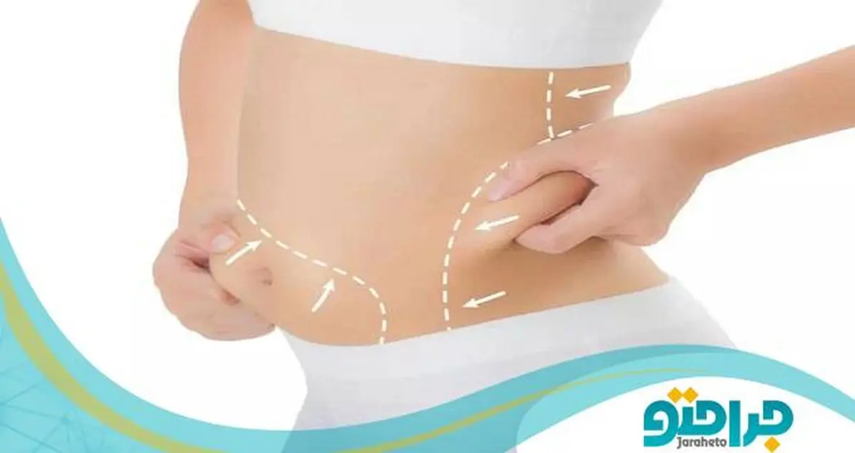 هزینه لیپوماتیک توسط بهترین پزشک در سال 1401 چقدر است ؟

