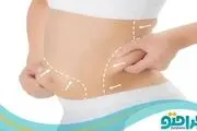 هزینه لیپوماتیک توسط بهترین پزشک در سال 1401 چقدر است ؟

