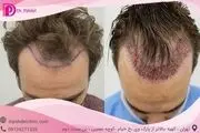 کاشت مو چگونه انجام می‌شود؟ انواع روش‌ها، عوارض
