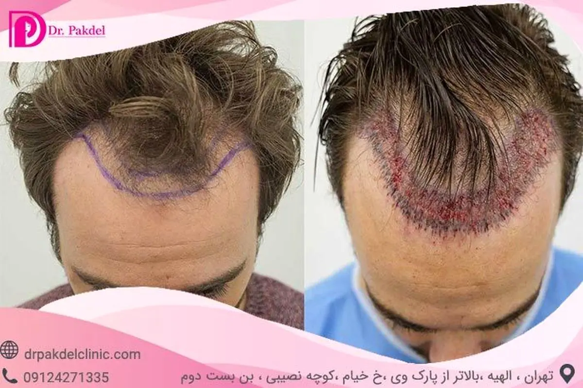 کاشت مو چگونه انجام میشود؟ انواع روشها، عوارض