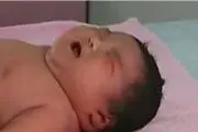 نوزادان سزارین بیشتر در معرض چاقی قرار دارند