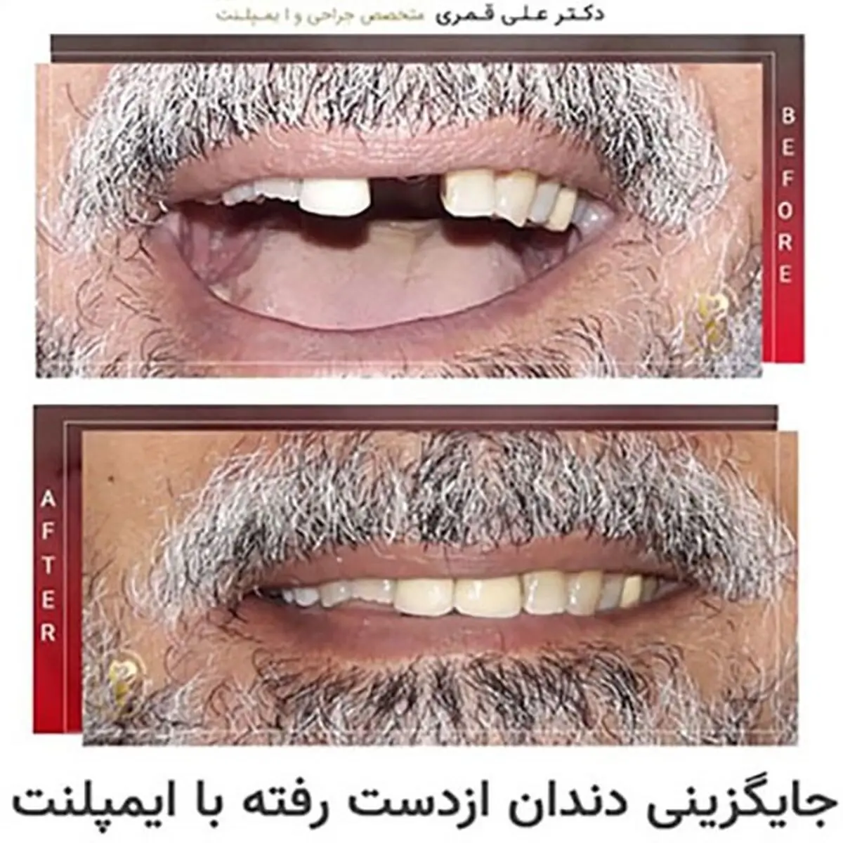 همه چیز در مورد ایمپلنت دندان
