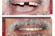 همه چیز در مورد ایمپلنت دندان
