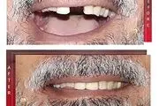 همه چیز در مورد ایمپلنت دندان
