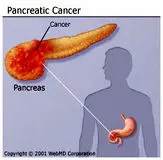 سرطان پانکراس، پنجمین سرطان کشنده