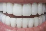 چگونه از بیماری های لثه و دندان پیشگیری کنیم؟