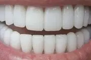 چگونه از بیماری های لثه و دندان پیشگیری کنیم؟