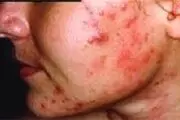ادویه‌ها جوش را تشدید می‌کند