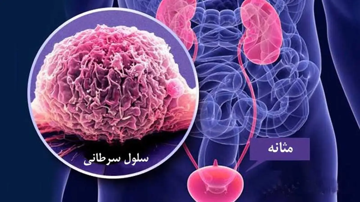 ۳ توصیه برای پیشگیری از سرطان مثانه