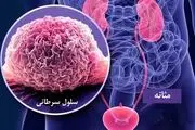 چه کسانی به سرطان مثانه مبتلا می‌شوند؟