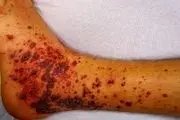 علامتی دردناک در پوست که نشانه سرطان است
