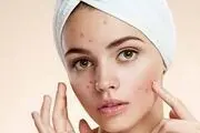  آکنه پریود را چگونه کنترل کنیم؟