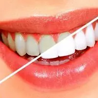 دندانهایتان را برای لبخند زیبا تراش ندهید