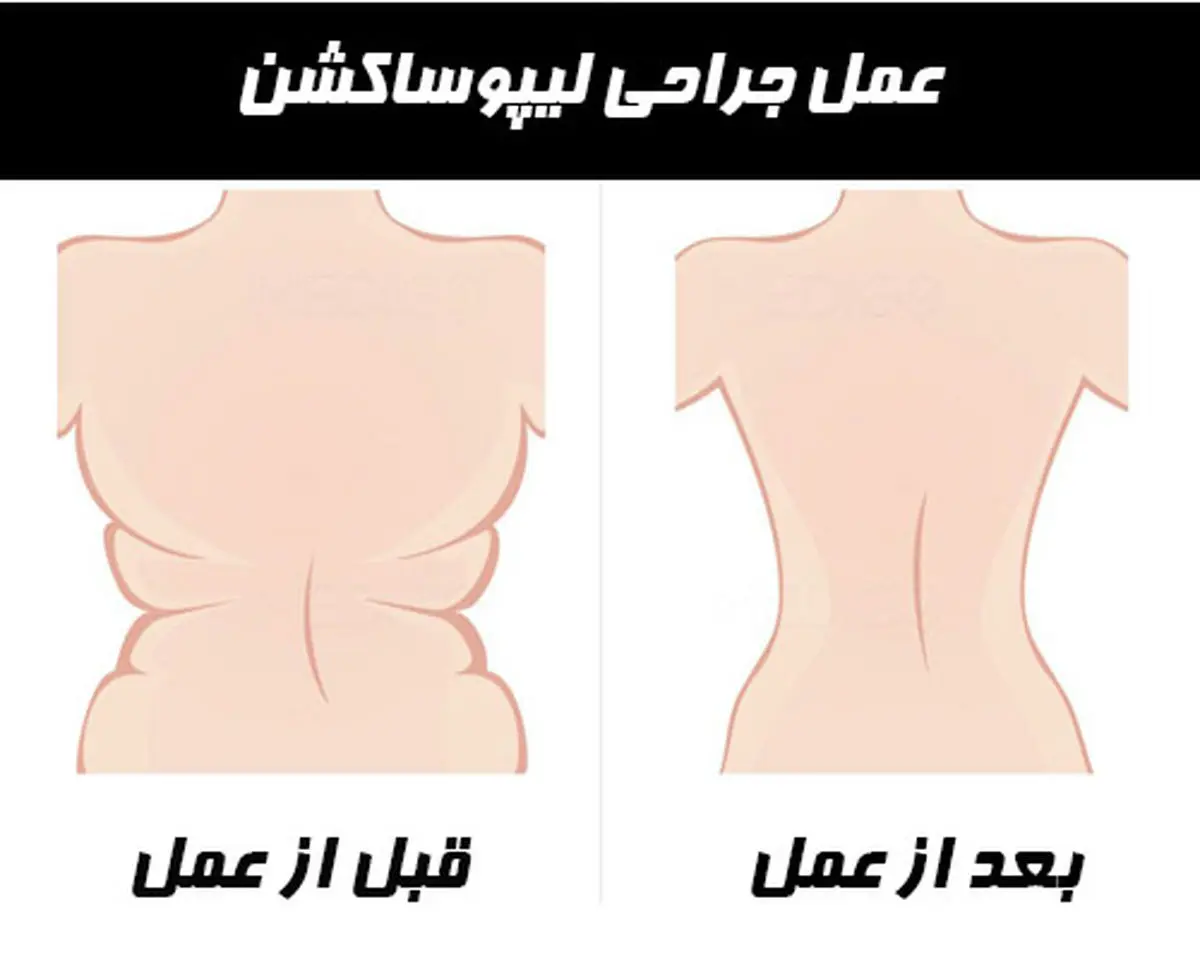 عمل لیپوساکشن کار دست زن 60 ساله داد