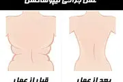 آنچه باید درباره «لیپوساکشن» بدانید
