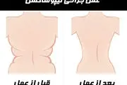مرگ زن صد کیلویی بعد از عمل لیپوساکشن
