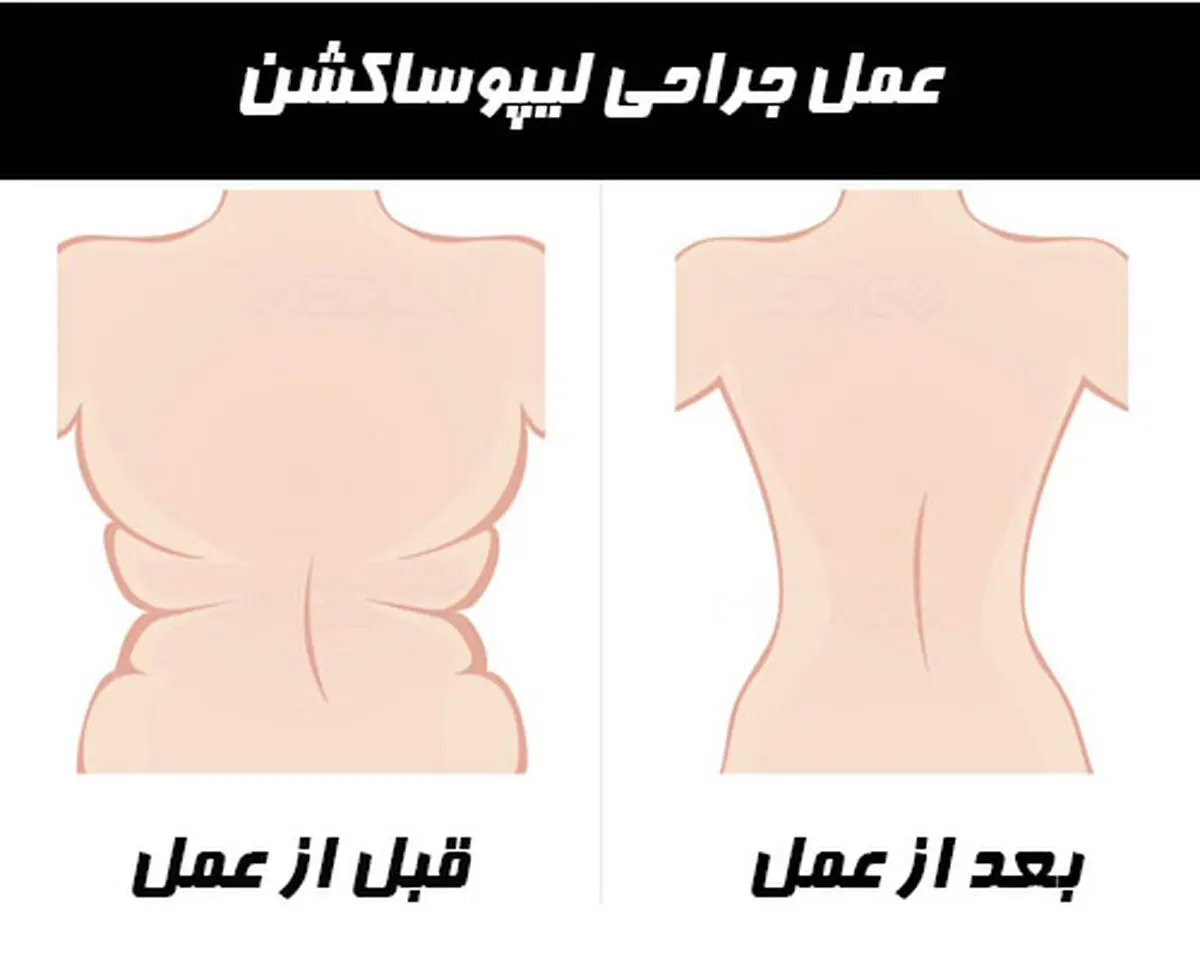 مرگ زن صد کیلویی بعد از عمل لیپوساکشن