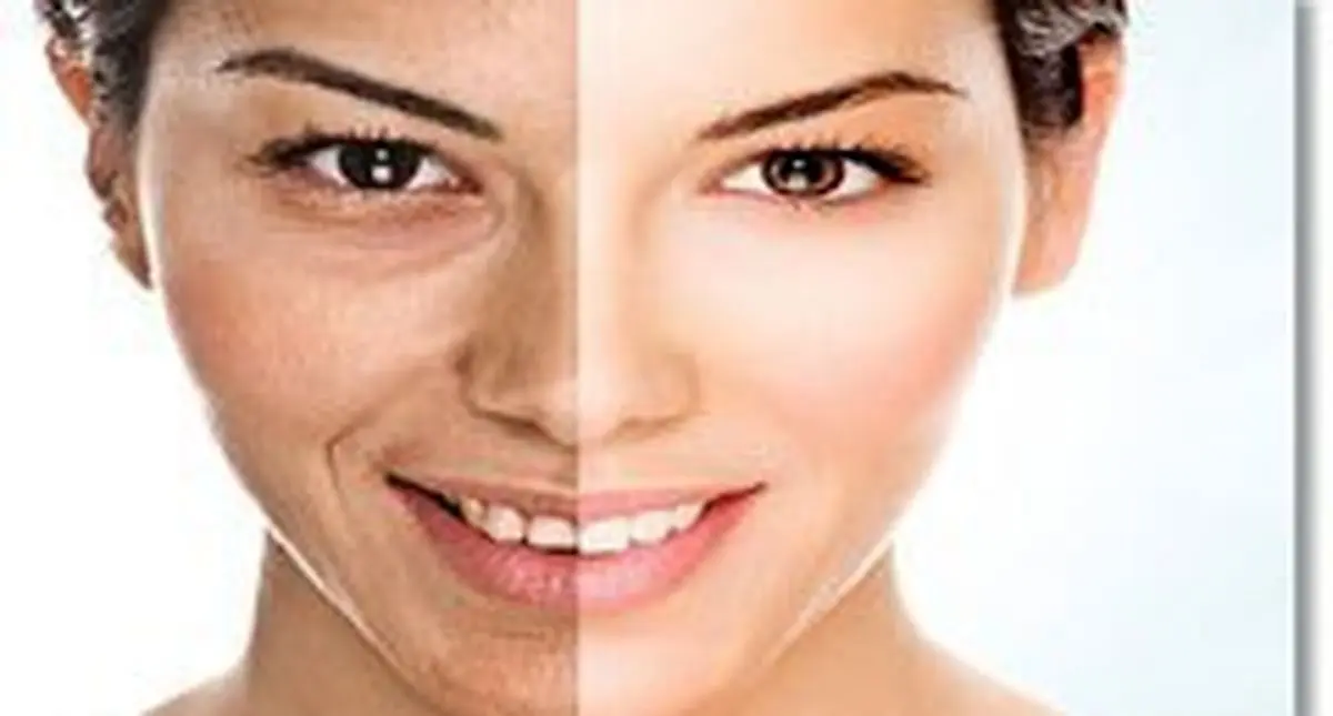 ابداع روشی جدید برای کاهش آثار زخم