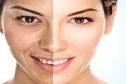 ابداع روشی جدید برای کاهش آثار زخم